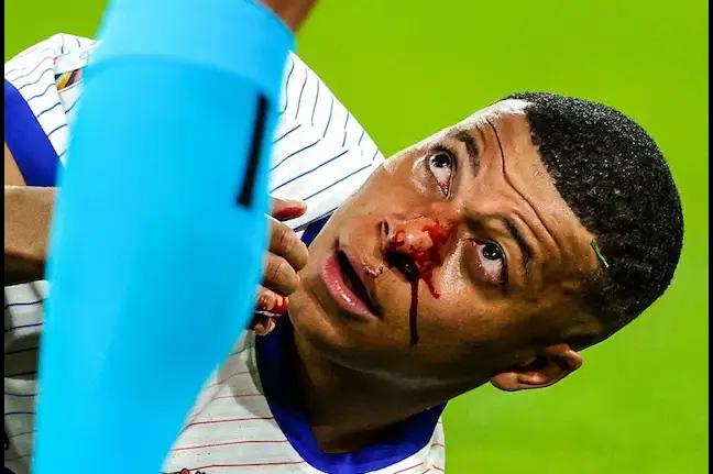 Kylian Mbappe's Status Unclear for France's EURO 2024 Match Against Netherlands